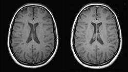 Photographie : IRM de cerveau atteint de sclérose en plaque