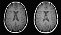 IRM de cerveau présentant une sclérose en plaque